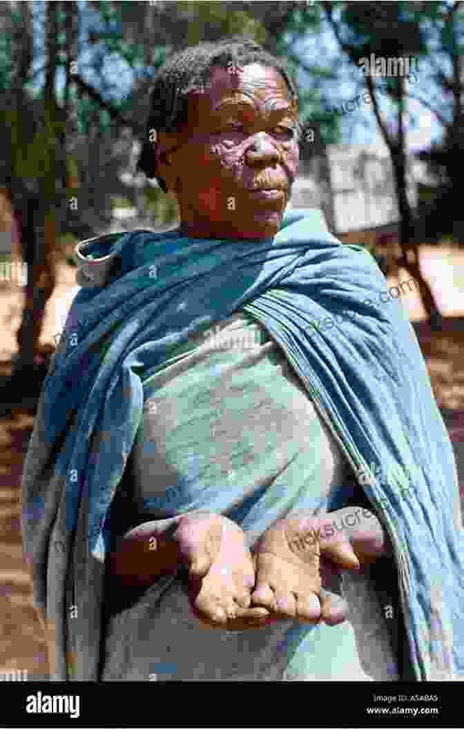 Photo Of A Woman With Leprosy, Showing The Visible Disfigurement And Social Isolation Caused By The Disease Carville S Cure: Leprosy Stigma And The Fight For Justice